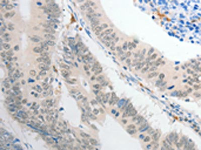The image on the left is immunohistochemistry of paraffin-embedded Human colon cancer tissue using CSB-PA162244(POU2F1 Antibody) at dilution 1/30, on the right is treated with fusion protein. (Original magnification: ×200)