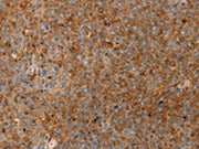The image on the left is immunohistochemistry of paraffin-embedded Human ovarian cancer tissue using CSB-PA162304(SERPINB2 Antibody) at dilution 1/20, on the right is treated with fusion protein. (Original magnification: ×200)