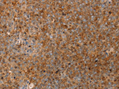 The image on the left is immunohistochemistry of paraffin-embedded Human ovarian cancer tissue using CSB-PA162304(SERPINB2 Antibody) at dilution 1/20, on the right is treated with fusion protein. (Original magnification: ×200)