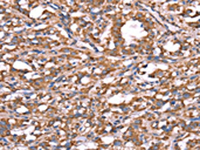 The image on the left is immunohistochemistry of paraffin-embedded Human thyroid cancer tissue using CSB-PA162393(SPAST Antibody) at dilution 1/20, on the right is treated with synthetic peptide. (Original magnification: ×200)