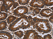 The image on the left is immunohistochemistry of paraffin-embedded Human colon cancer tissue using CSB-PA162395(CERS5 Antibody) at dilution 1/35, on the right is treated with synthetic peptide. (Original magnification: ×200)