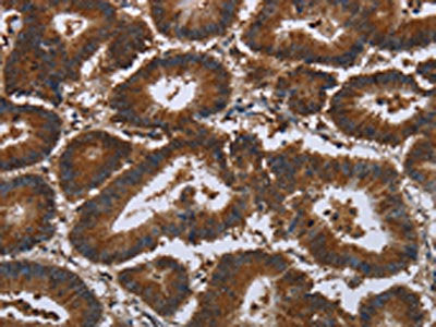 The image on the left is immunohistochemistry of paraffin-embedded Human colon cancer tissue using CSB-PA162395(CERS5 Antibody) at dilution 1/35, on the right is treated with synthetic peptide. (Original magnification: ×200)