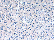 The image on the left is immunohistochemistry of paraffin-embedded Human liver cancer tissue using CSB-PA162500(RAB2A Antibody) at dilution 1/30, on the right is treated with synthetic peptide. (Original magnification: ×200)