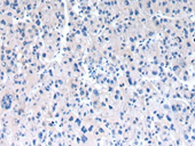 The image on the left is immunohistochemistry of paraffin-embedded Human liver cancer tissue using CSB-PA162500(RAB2A Antibody) at dilution 1/30, on the right is treated with synthetic peptide. (Original magnification: ×200)