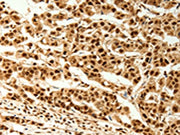 The image on the left is immunohistochemistry of paraffin-embedded Human cervical cancer tissue using CSB-PA162542(TIGAR Antibody) at dilution 1/80, on the right is treated with synthetic peptide. (Original magnification: ×200)