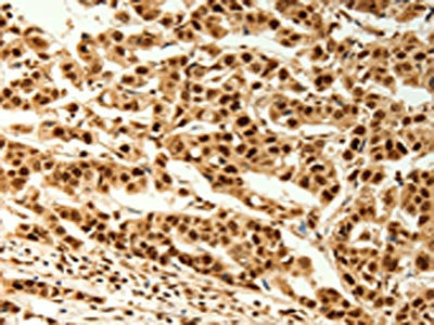 The image on the left is immunohistochemistry of paraffin-embedded Human cervical cancer tissue using CSB-PA162542(TIGAR Antibody) at dilution 1/80, on the right is treated with synthetic peptide. (Original magnification: ×200)