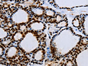 The image on the left is immunohistochemistry of paraffin-embedded Human thyroid cancer tissue using CSB-PA162597(EGFR Antibody) at dilution 1/15, on the right is treated with synthetic peptide. (Original magnification: ×200)
