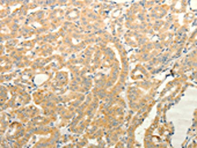 The image on the left is immunohistochemistry of paraffin-embedded Human thyroid cancer tissue using CSB-PA162676(TPH1 Antibody) at dilution 1/20, on the right is treated with fusion protein. (Original magnification: ×200)