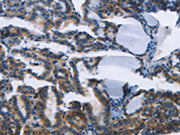 The image on the left is immunohistochemistry of paraffin-embedded Human thyroid cancer tissue using CSB-PA162717(TWF2 Antibody) at dilution 1/30, on the right is treated with fusion protein. (Original magnification: ×200)