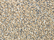 The image on the left is immunohistochemistry of paraffin-embedded Human prostate cancer tissue using CSB-PA162779(TUBA1C Antibody) at dilution 1/20, on the right is treated with fusion protein. (Original magnification: ×200)