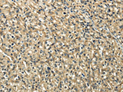The image on the left is immunohistochemistry of paraffin-embedded Human prostate cancer tissue using CSB-PA162779(TUBA1C Antibody) at dilution 1/20, on the right is treated with fusion protein. (Original magnification: ×200)