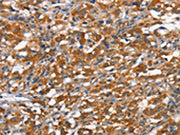 The image on the left is immunohistochemistry of paraffin-embedded Human thyroid cancer tissue using CSB-PA162889(HMMR Antibody) at dilution 1/40, on the right is treated with synthetic peptide. (Original magnification: ×200)
