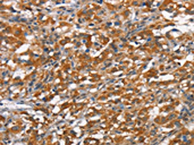 The image on the left is immunohistochemistry of paraffin-embedded Human thyroid cancer tissue using CSB-PA162889(HMMR Antibody) at dilution 1/40, on the right is treated with synthetic peptide. (Original magnification: ×200)