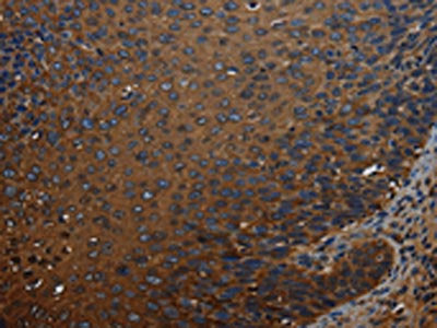 The image on the left is immunohistochemistry of paraffin-embedded Human cervical cancer tissue using CSB-PA162892(IVL Antibody) at dilution 1/50, on the right is treated with synthetic peptide. (Original magnification: ×200)