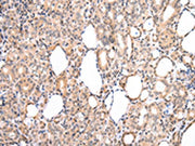 The image on the left is immunohistochemistry of paraffin-embedded Human thyroid cancer tissue using CSB-PA162953(CDK8 Antibody) at dilution 1/20, on the right is treated with synthetic peptide. (Original magnification: ×200)