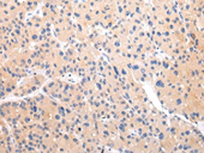 The image on the left is immunohistochemistry of paraffin-embedded Human liver cancer tissue using CSB-PA163015(ZNF106 Antibody) at dilution 1/20, on the right is treated with synthetic peptide. (Original magnification: ×200)
