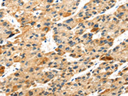 The image on the left is immunohistochemistry of paraffin-embedded Human liver cancer tissue using CSB-PA163063(S100A14 Antibody) at dilution 1/30, on the right is treated with fusion protein. (Original magnification: ×200)
