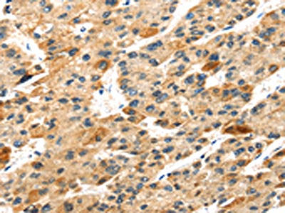 The image on the left is immunohistochemistry of paraffin-embedded Human liver cancer tissue using CSB-PA163063(S100A14 Antibody) at dilution 1/30, on the right is treated with fusion protein. (Original magnification: ×200)