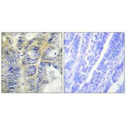 Immunohistochemistry analysis of paraffin-embedded human colon carcinoma tissue using Collagen IV α5 antibody.