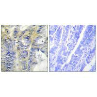 Immunohistochemistry analysis of paraffin-embedded human colon carcinoma tissue using Collagen IV α5 antibody.