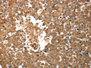 The image on the left is immunohistochemistry of paraffin-embedded Human breast cancer tissue using CSB-PA163258(SLC22A6 Antibody) at dilution 1/50, on the right is treated with synthetic peptide. (Original magnification: ×200)
