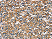 The image on the left is immunohistochemistry of paraffin-embedded Human thyroid cancer tissue using CSB-PA163318(APOA1BP Antibody) at dilution 1/15, on the right is treated with synthetic peptide. (Original magnification: ×200)