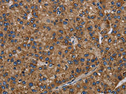 The image on the left is immunohistochemistry of paraffin-embedded Human liver cancer tissue using CSB-PA163325(PVRL2 Antibody) at dilution 1/40, on the right is treated with fusion protein. (Original magnification: ×200)
