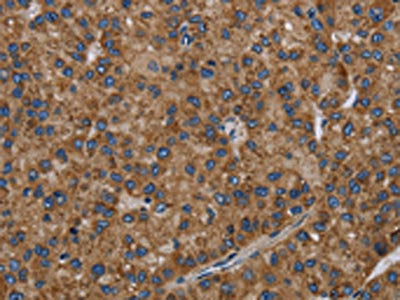 The image on the left is immunohistochemistry of paraffin-embedded Human liver cancer tissue using CSB-PA163325(PVRL2 Antibody) at dilution 1/40, on the right is treated with fusion protein. (Original magnification: ×200)