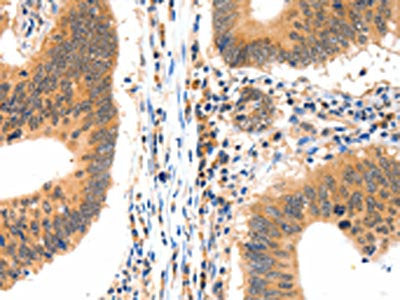 The image on the left is immunohistochemistry of paraffin-embedded Human colon cancer tissue using CSB-PA163355(LRPPRC Antibody) at dilution 1/15, on the right is treated with synthetic peptide. (Original magnification: ×200)