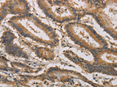The image on the left is immunohistochemistry of paraffin-embedded Human colon cancer tissue using CSB-PA163406(CLEC5A Antibody) at dilution 1/20, on the right is treated with synthetic peptide. (Original magnification: ×200)