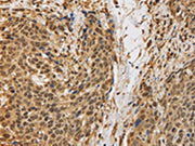 The image on the left is immunohistochemistry of paraffin-embedded Human cervical cancer tissue using CSB-PA163656(BRAF Antibody) at dilution 1/30, on the right is treated with synthetic peptide. (Original magnification: ×200)