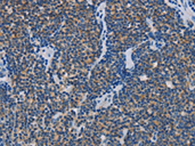 The image on the left is immunohistochemistry of paraffin-embedded Human lymphoma tissue using CSB-PA163788(AMBRA1 Antibody) at dilution 1/25, on the right is treated with fusion protein. (Original magnification: ×200)