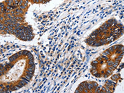 The image on the left is immunohistochemistry of paraffin-embedded Human colon cancer tissue using CSB-PA164023(CDH1 Antibody) at dilution 1/100, on the right is treated with synthetic peptide. (Original magnification: x200)