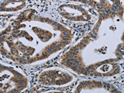 The image on the left is immunohistochemistry of paraffin-embedded Human gastic cancer tissue using CSB-PA164096(GNG2 Antibody) at dilution 1/50, on the right is treated with fusion protein. (Original magnification: ×200)