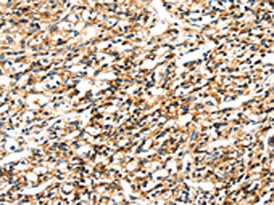 The image on the left is immunohistochemistry of paraffin-embedded Human prostate cancer tissue using CSB-PA164146(SEMA4A Antibody) at dilution 1/30, on the right is treated with fusion protein. (Original magnification: ×200)
