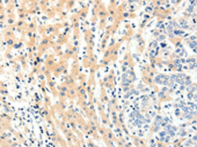 The image on the left is immunohistochemistry of paraffin-embedded Human breast cancer tissue using CSB-PA164310(PAK7 Antibody) at dilution 1/20, on the right is treated with fusion protein. (Original magnification: ×200)