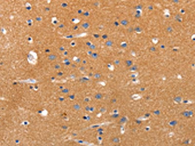 The image on the left is immunohistochemistry of paraffin-embedded Human brain tissue using CSB-PA164401(JAK2 Antibody) at dilution 1/35, on the right is treated with synthetic peptide. (Original magnification: ×200)