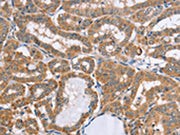 The image on the left is immunohistochemistry of paraffin-embedded Human thyroid cancer tissue using CSB-PA164416(MSMB Antibody) at dilution 1/20, on the right is treated with fusion protein. (Original magnification: ×200)