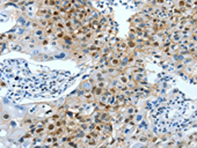 The image on the left is immunohistochemistry of paraffin-embedded Human lung cancer tissue using CSB-PA164448(JUN Antibody) at dilution 1/30, on the right is treated with fusion protein. (Original magnification: ×200)