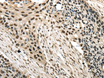 The image on the left is immunohistochemistry of paraffin-embedded Human esophagus cancer tissue using CSB-PA164566(TRIM11 Antibody) at dilution 1/20, on the right is treated with fusion protein. (Original magnification: ×200)