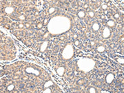 The image on the left is immunohistochemistry of paraffin-embedded Human thyroid cancer tissue using CSB-PA164632(VPS54 Antibody) at dilution 1/30, on the right is treated with fusion protein. (Original magnification: ×200)