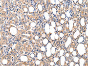The image on the left is immunohistochemistry of paraffin-embedded Human thyroid cancer tissue using CSB-PA164672(CMKLR1 Antibody) at dilution 1/35, on the right is treated with synthetic peptide. (Original magnification: ×200)