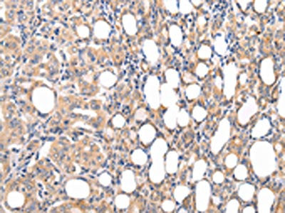 The image on the left is immunohistochemistry of paraffin-embedded Human thyroid cancer tissue using CSB-PA164672(CMKLR1 Antibody) at dilution 1/35, on the right is treated with synthetic peptide. (Original magnification: ×200)