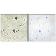 Immunohistochemical analysis of paraffin-embedded human breast carcinoma tissue using FGFR3 antibody.