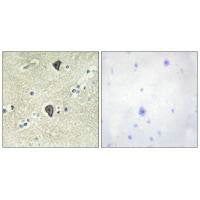 Immunohistochemical analysis of paraffin-embedded human breast carcinoma tissue using FGFR3 antibody.
