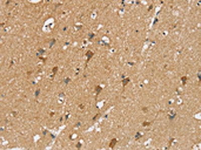 The image on the left is immunohistochemistry of paraffin-embedded Human brain tissue using CSB-PA165026(SIAH2 Antibody) at dilution 1/20, on the right is treated with synthetic peptide. (Original magnification: ×200)