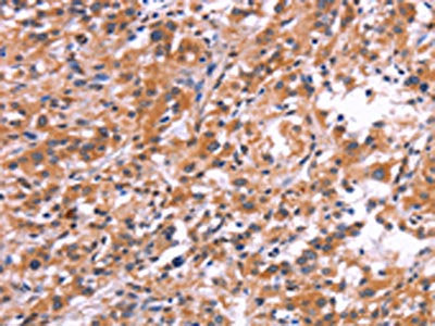 The image on the left is immunohistochemistry of paraffin-embedded Human thyroid cancer tissue using CSB-PA165039(APMAP Antibody) at dilution 1/30, on the right is treated with synthetic peptide. (Original magnification: ×200)