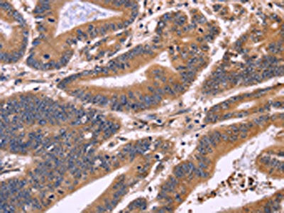 The image on the left is immunohistochemistry of paraffin-embedded Human colon cancer tissue using CSB-PA165136(S100A13 Antibody) at dilution 1/40, on the right is treated with fusion protein. (Original magnification: ×200)