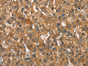The image on the left is immunohistochemistry of paraffin-embedded Human liver cancer tissue using CSB-PA165586(APOA1BP Antibody) at dilution 1/30, on the right is treated with synthetic peptide. (Original magnification: ×200)