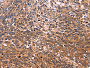 The image on the left is immunohistochemistry of paraffin-embedded Human cervical cancer tissue using CSB-PA165659(GCG Antibody) at dilution 1/20, on the right is treated with synthetic peptide. (Original magnification: ×200)